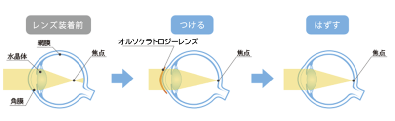 戸田眼科　東広島クリニック（公式） オルソケラトロジー治療のご案内